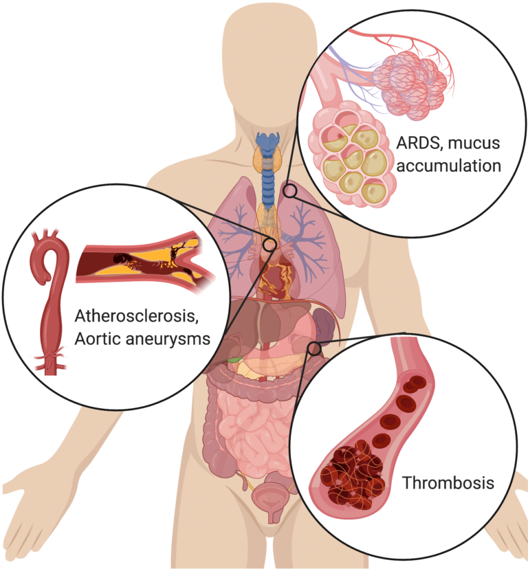 Severe COVID-19 symptoms may be caused by overactive neutrophils