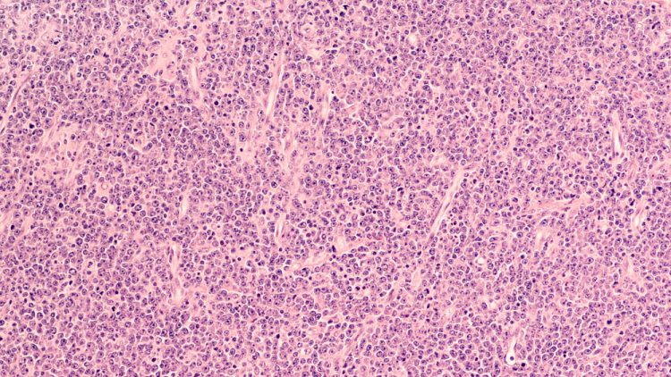 Mantle Cell Lymphoma - News, Articles, Whitepapers - Drug Target Review