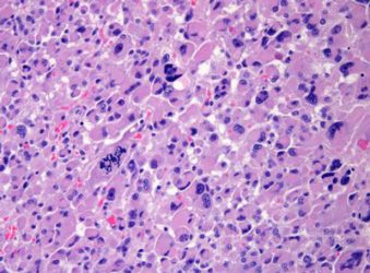 Researchers identify new genetic drivers of adrenal cancer