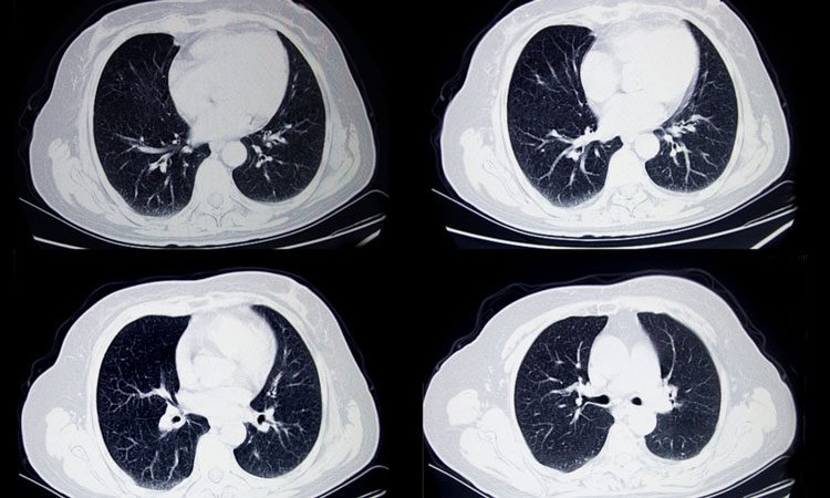 https://www.drugtargetreview.com/wp-content/uploads/lung-cancer-2-750x450.jpg