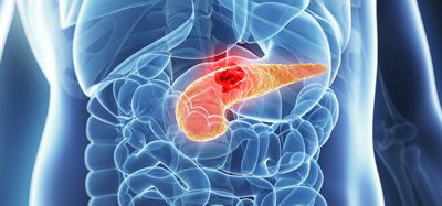 pancreatic cancer