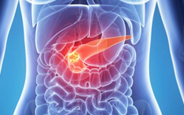 Biomarkers could identify early risk of pancreatic cancer