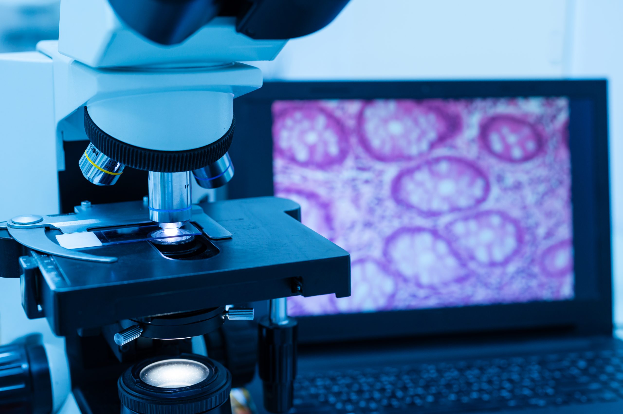 Modern microscope and human tissue section slide with computer monitor show glandular image.Medical patholology and cytologytechnology concept.