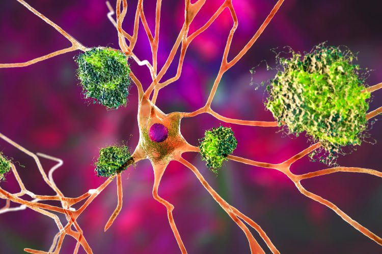 amyloid plaques on Alzheimer's disease neurons