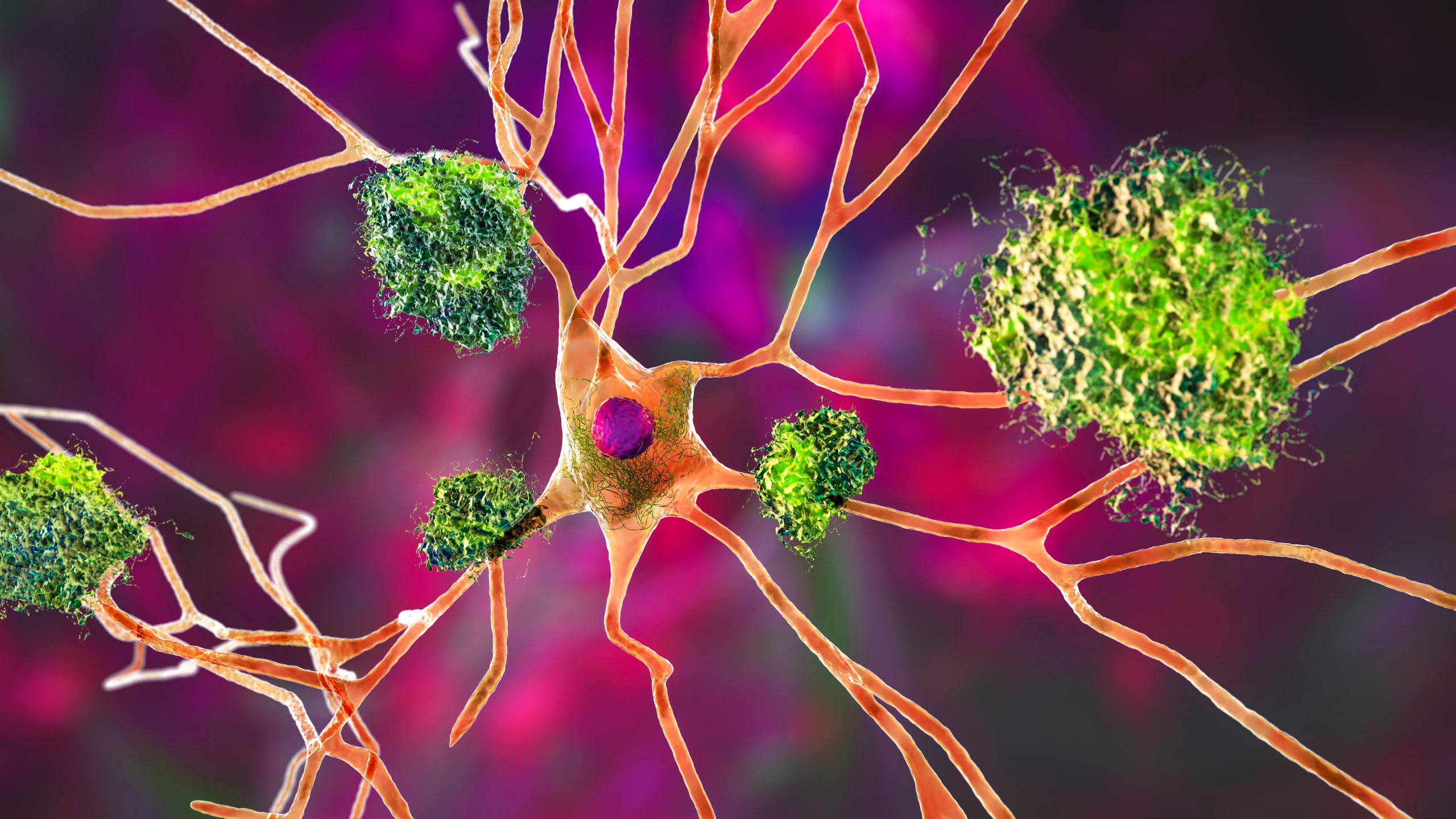 amyloid plaques on Alzheimer's disease neurons