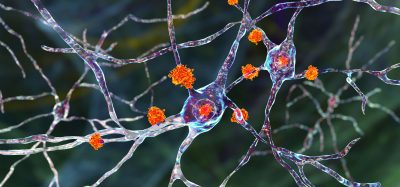 Neuronal inclusions in Huntington's disease, 3D illustration. Inclusions are composed of mutated huntingtin protein, they are initially formed at axons and dendrites, then migrate to nuclei of neurons