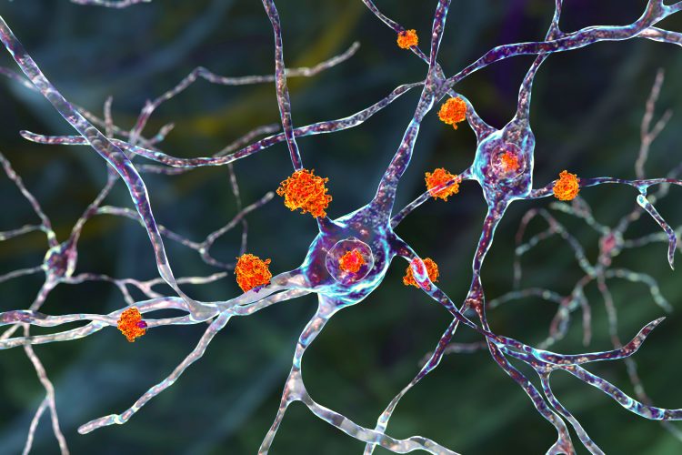 Neuronal inclusions in Huntington's disease, 3D illustration. Inclusions are composed of mutated huntingtin protein, they are initially formed at axons and dendrites, then migrate to nuclei of neurons