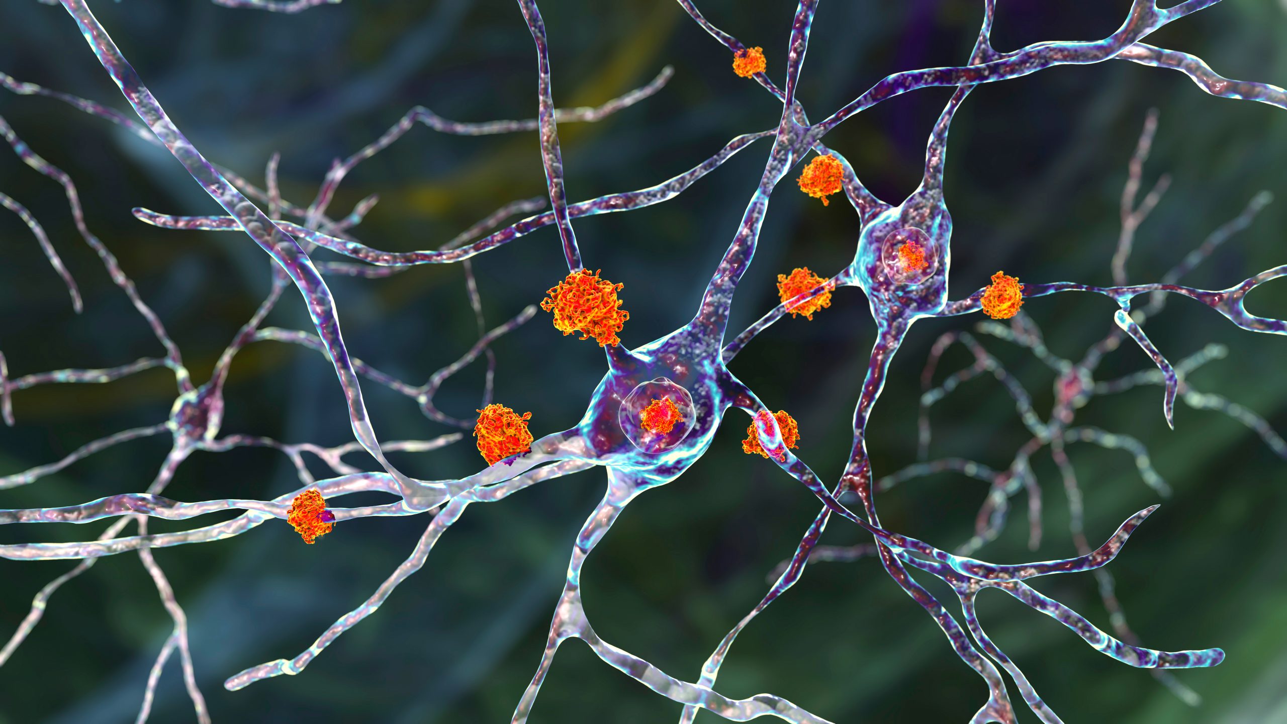 Neuronal inclusions in Huntington's disease, 3D illustration. Inclusions are composed of mutated huntingtin protein, they are initially formed at axons and dendrites, then migrate to nuclei of neurons