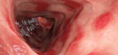 ulcerative colitis