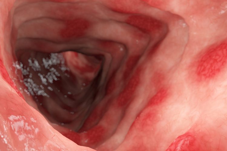 ulcerative colitis