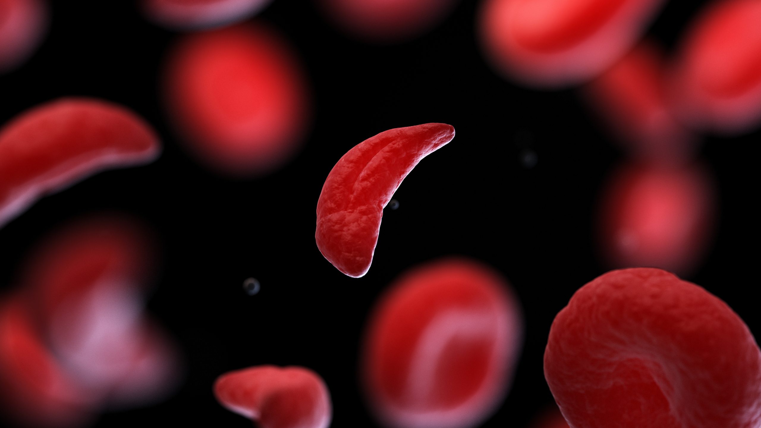 sickle cell disease illustration