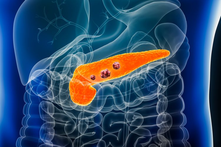 Pancreas or pancreatic cancer with organs and tumors or cancerous cells 3D rendering illustration with male body. Anatomy, oncology, disease, medical, biology, science, healthcare concepts.