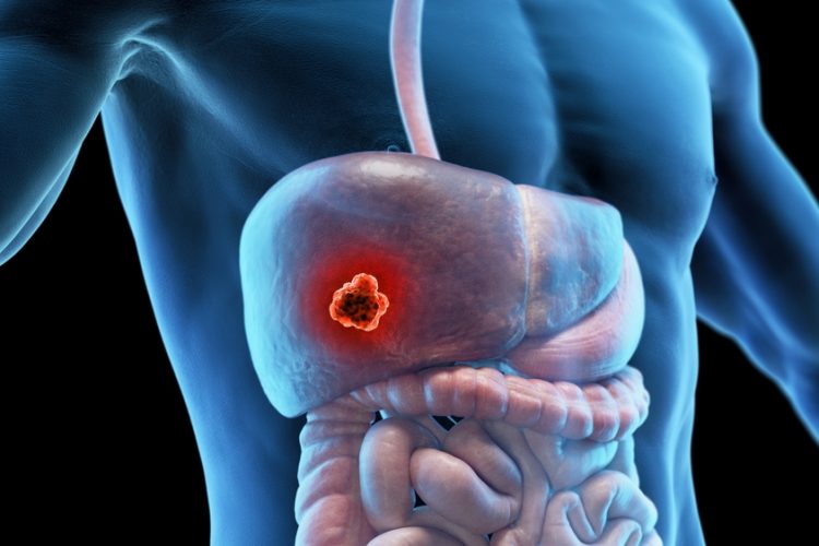 liver cancer