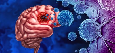 Glioma Cancer Tumor as malignant cells outbreak as a brain disease attacking neurons as a medical concept of neurological disease with 3D illustration elements.