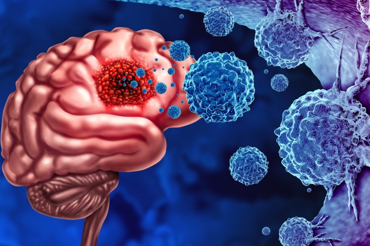 Glioma Cancer Tumor as malignant cells outbreak as a brain disease attacking neurons as a medical concept of neurological disease with 3D illustration elements.