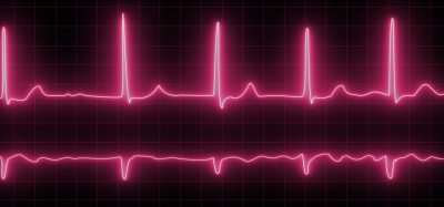 Electrocardiogram with cardiac arrhythmia. Neon atrial fibrillation has been recorded as the source of many cerebrovascular accidents or strokes