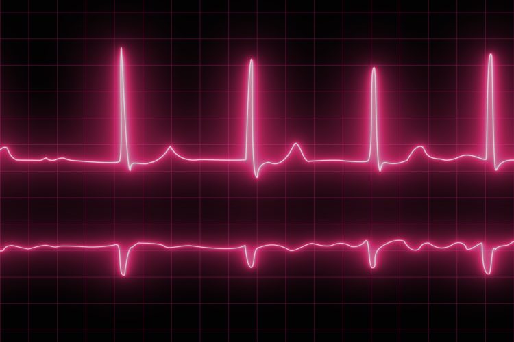 Electrocardiogram with cardiac arrhythmia. Neon atrial fibrillation has been recorded as the source of many cerebrovascular accidents or strokes