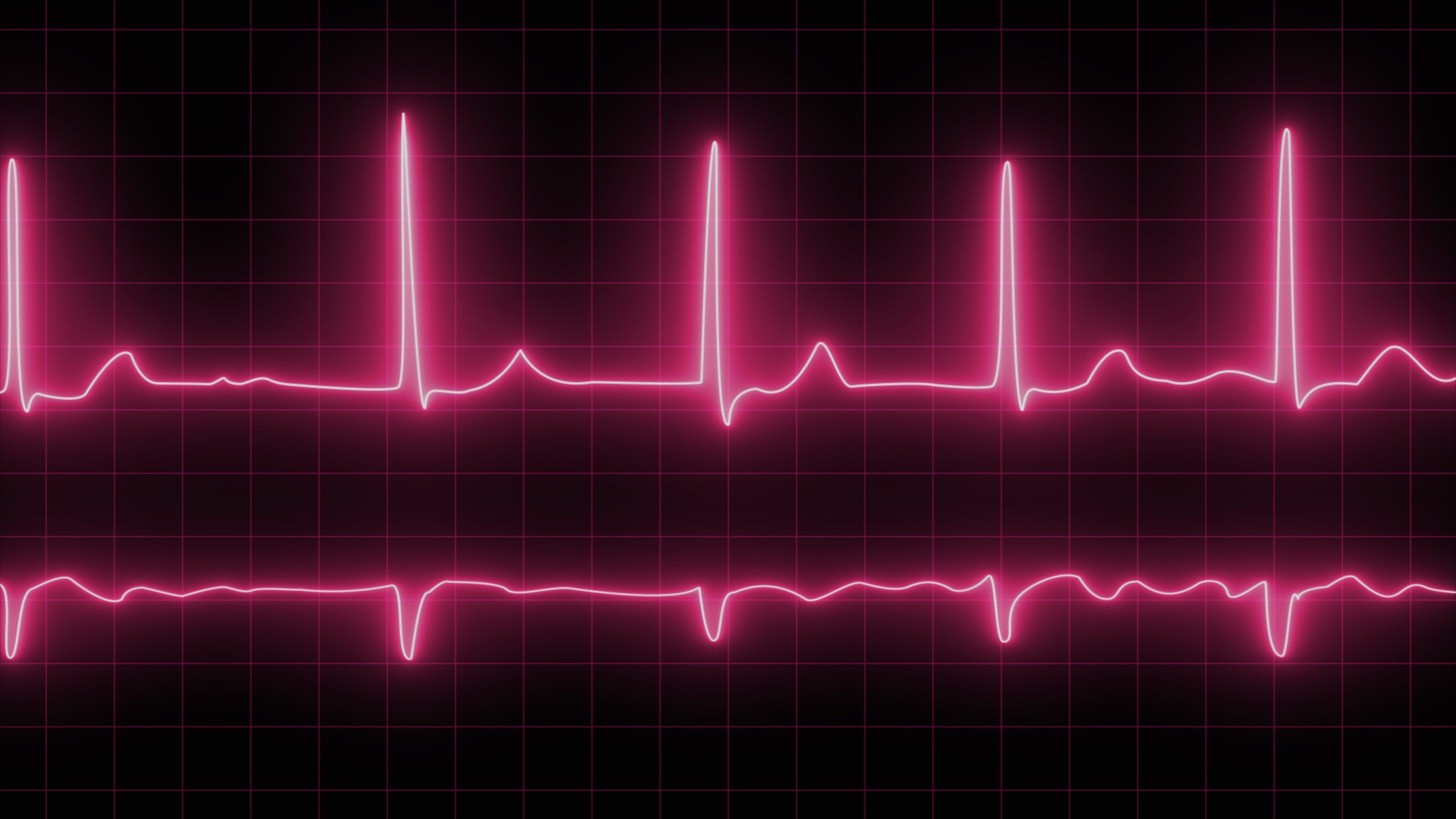 Electrocardiogram with cardiac arrhythmia. Neon atrial fibrillation has been recorded as the source of many cerebrovascular accidents or strokes