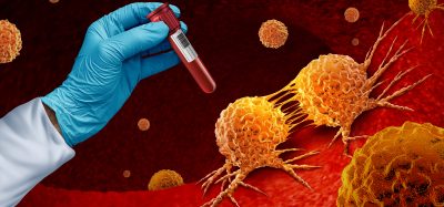 Cancer blood test and malignant disease screening for early detection of cancers