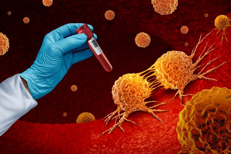 Cancer blood test and malignant disease screening for early detection of cancers