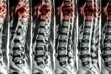 Exploring future spinal cord injury therapies - Drug Target Review